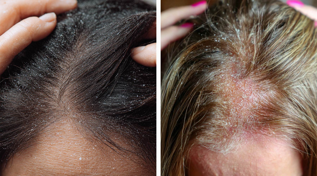 Two images of hair showing dandruff on the scalp. 
