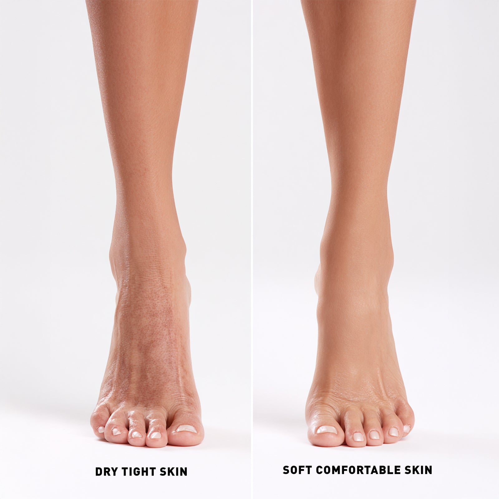 Comparison of dry tight skin and soft comfortable skin on feet against a white background