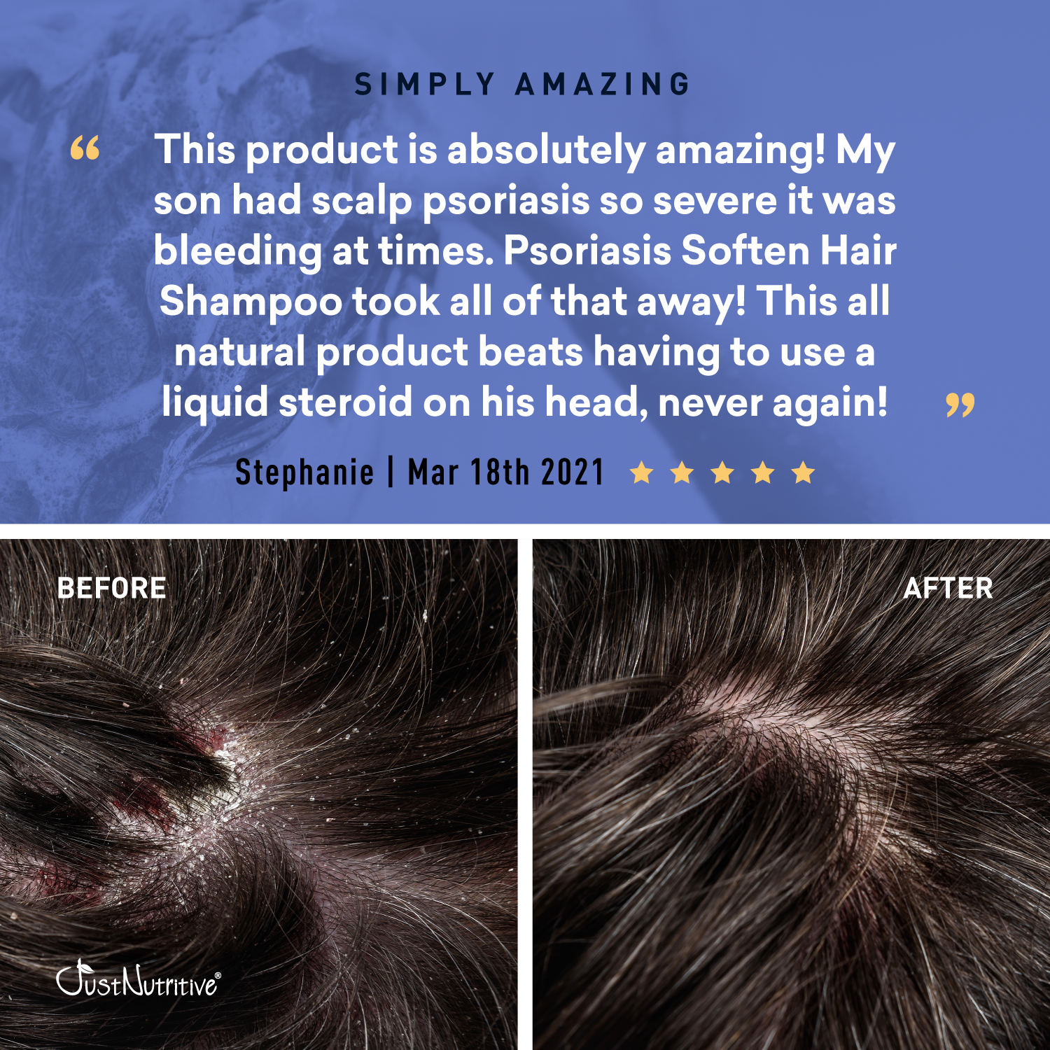 Product review for psoriasis softening shampoo with before and after images and customer testimonial.