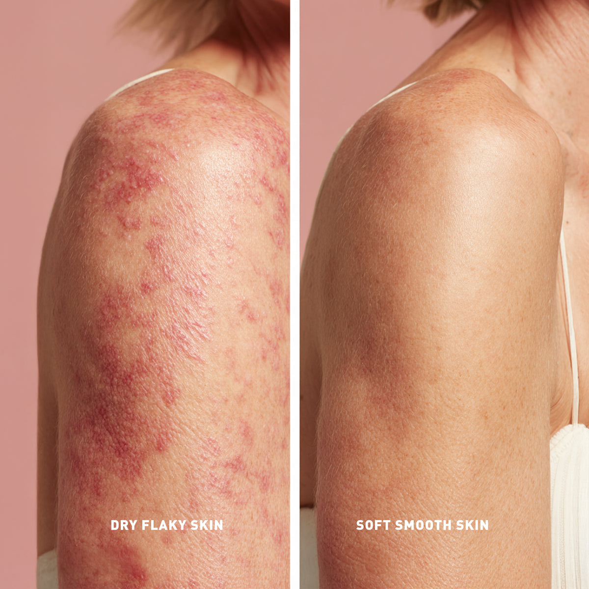 Before and after comparison of dry flaky skin on a shoulder with soft smooth skin.