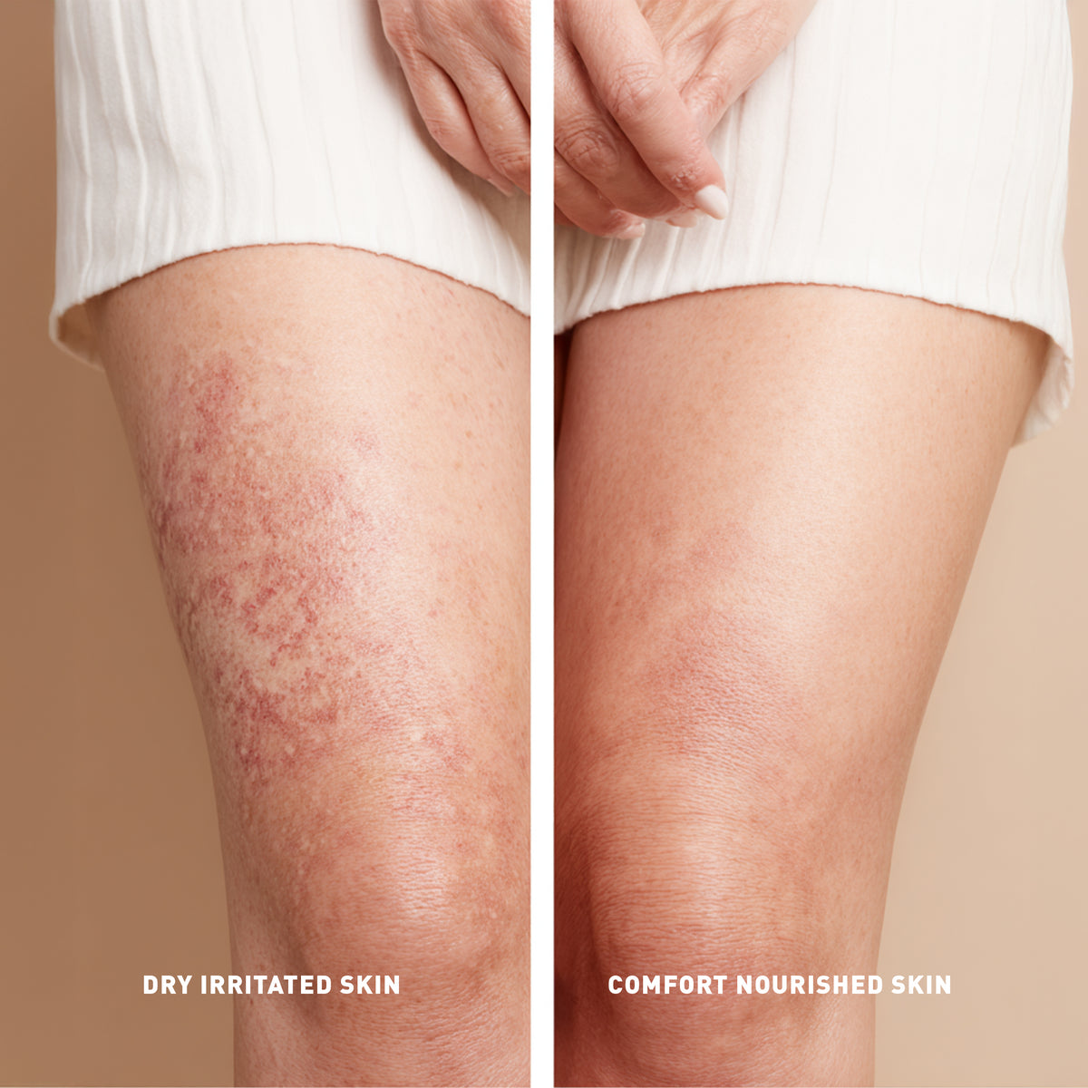 Comparison of dry irritated skin on one leg and comfort nourished skin on the other, against a beige background.